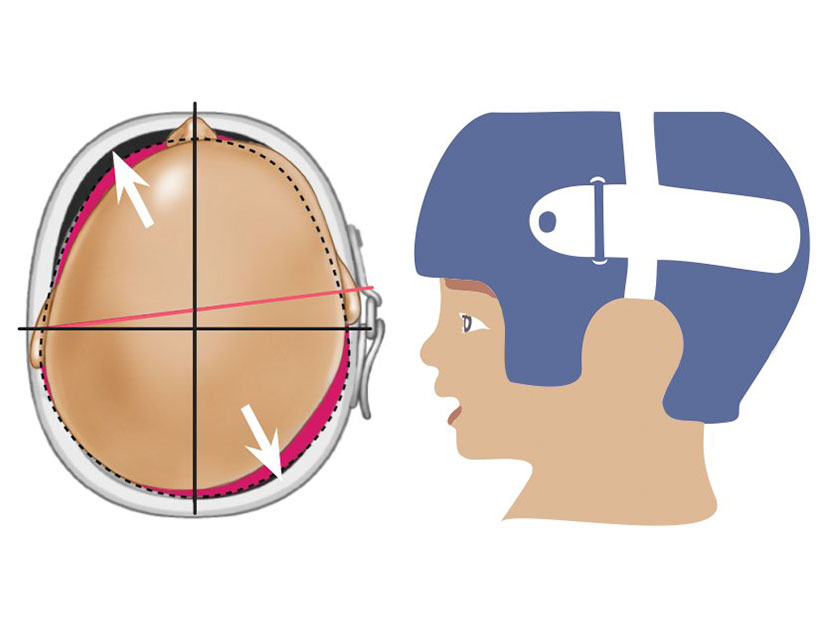 como funciona ortese.jpg